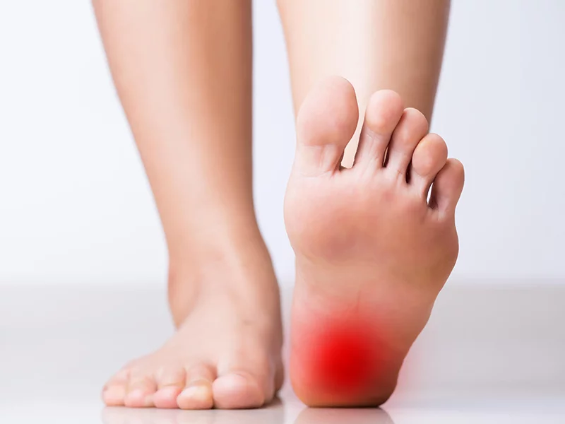 Ostrogi piętowe – zapalenie przyczepu piętowego rozcięgna podeszwowego stopy