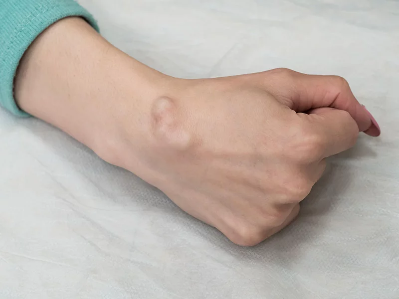 Sprawdź w Atlanta Clinic: <strong>Ganglion </strong> – torbiel galaretowata